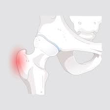 Τροχαντηρίτιδα – πόνος στην εξωτερική πλευρά του ισχίου